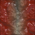 Colon Cancer