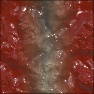 Colon Cancer